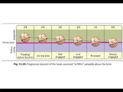 Obstetrics 167 Engagement Head Breech Fetus Baby labor define why not ...