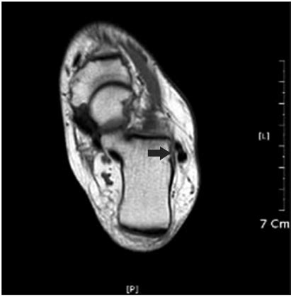 Peroneus Tertius Mri