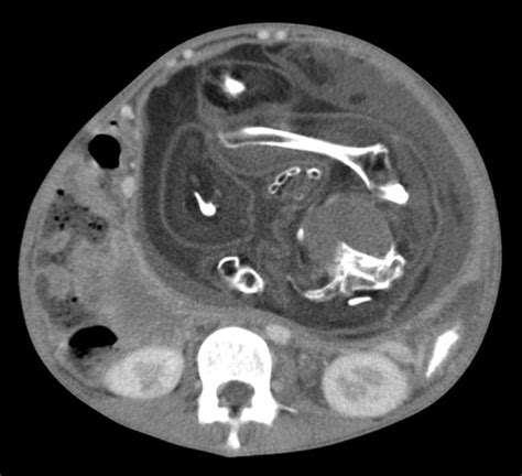 Fetus In Fetu Ultrasound