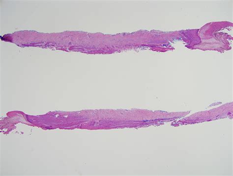 Onychopapilloma with Supervening Warty Changes | Dermatopathology