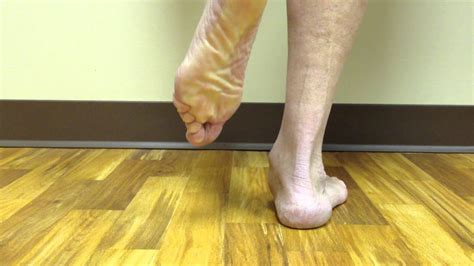 Posterior Tibial Tendon Dysfunction, Post-Treatment - YouTube