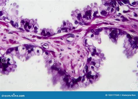 Prostate Cancer, Light Micrograph Stock Image - Image of magnification ...