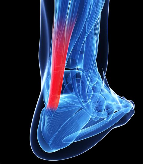 Tendinosis Treatment: Healing Tendon Injuries | NKJ Institute