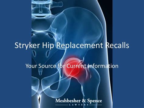 Stryker Hip Replacement Recall - Your Source for Information