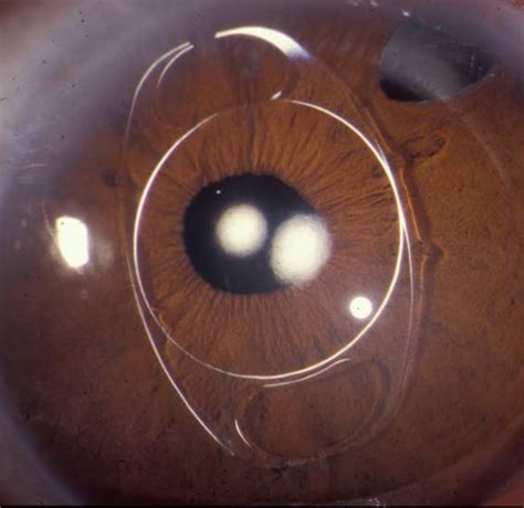 Megalocornea. EyeRounds.org - Ophthalmology - The University of Iowa