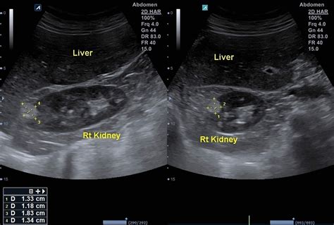 Angiomyolipoma or renal angiomyolipoma, causes, symptoms & treatment