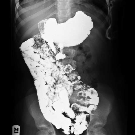 Intestinal malrotation - abnormal distribution of the small bowel. The duodenum fails to cross ...