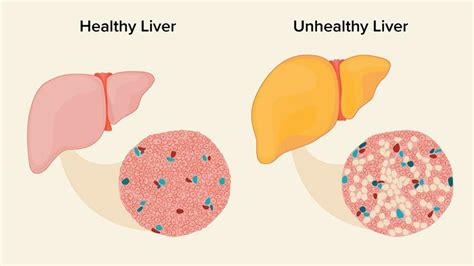 Elevated Liver Enzymes: What It is, Causes, Prevention, and Treatment ...