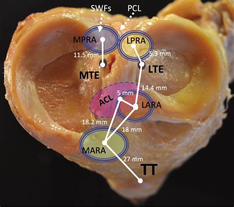 Meniscal root tears: Solving the silent epidemic - Journal of ...