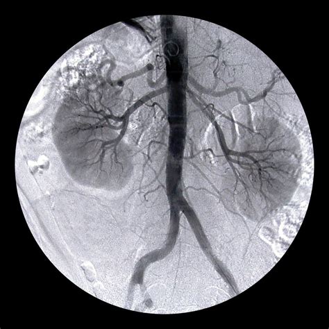 What are the Complications of Endovascular Aneurysm Repair?