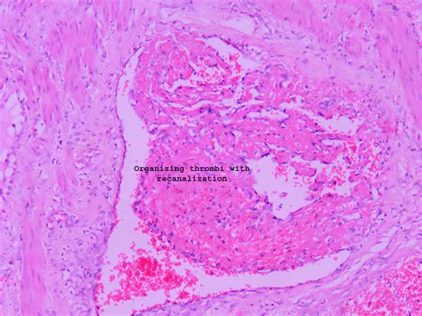 Organizing thrombi – Histopathology.guru