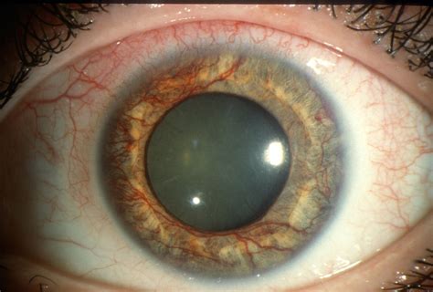 Moran CORE | Neovascularization of the Iris (Rubeosis Iridis)