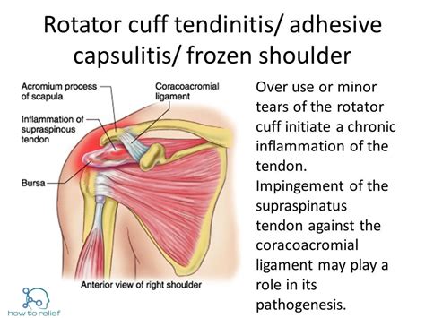 Rotator Cuff vs Frozen Shoulder » How To Relief