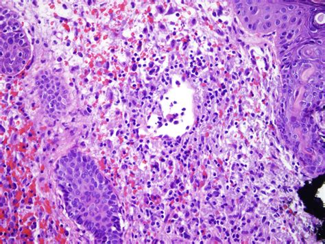 Granuloma Faciale | Dermatopathology