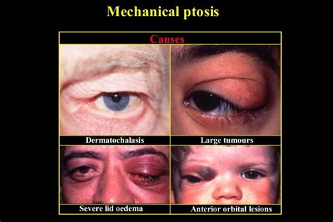 ptosis ppt