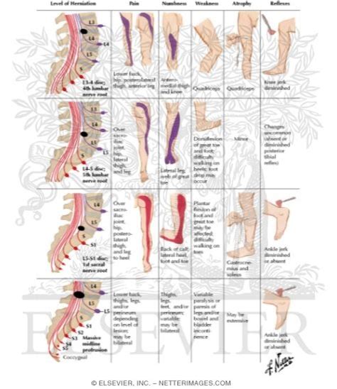 Herniated Nucleus Pulposus (Lumbar); Clinical Features