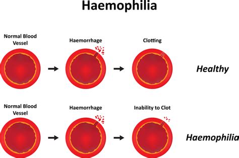 Hemophilia: MedlinePlus Genetics