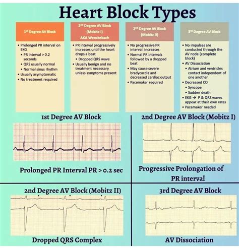 Heart Block Types - MEDizzy