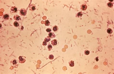 Shigellosis (Shigella Infection) Causes, Signs, Treatment & Prevention