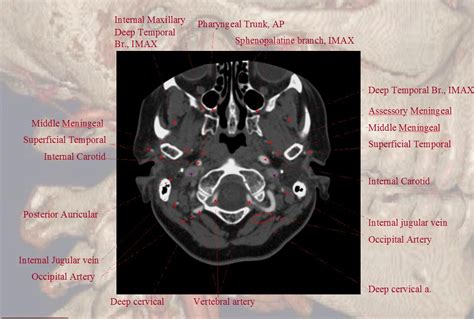 r@diOlogY dE aruN: Carotid Angio CT Vascular Anatomy