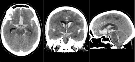 Radiology MRI: Anterior Communicating Artery Aneurysm Rupture