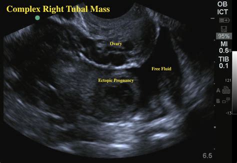 Ectopic Pregnancy Ultrasound