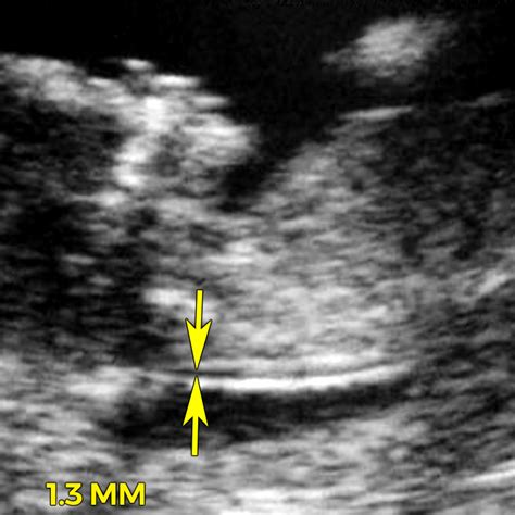 Nuchal translucency (NT) ultrasound - BabyCenter Canada