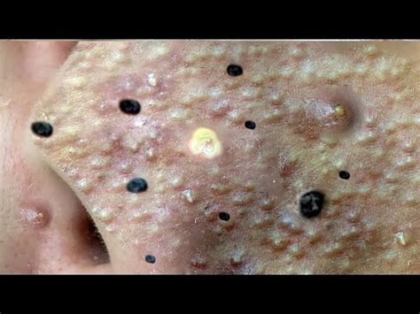 Ear Blackhead professional extraction - Full Video of blackhead removal ...