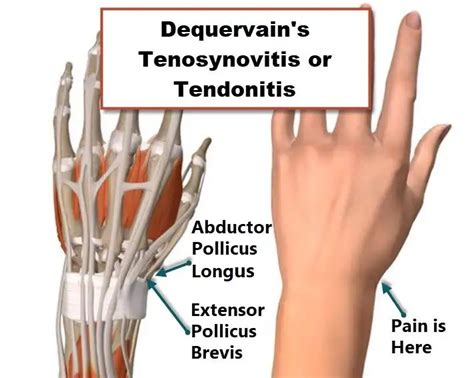 Wrist Tendon Anatomy