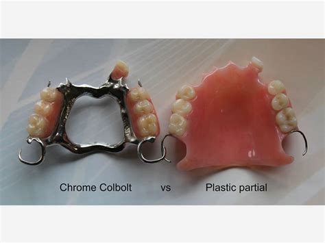 Partial Dentures – Denture Services | Dental Solutions West