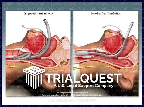 Placement of Laryngeal Mask Airway - TrialExhibits Inc.