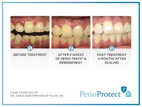 How To Heal Gum Disease - Warexamination15