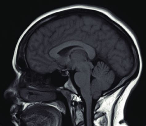 Sagittal MRI at diagnosis demonstrated 4 mm of cerebellar tonsillar... | Download Scientific Diagram