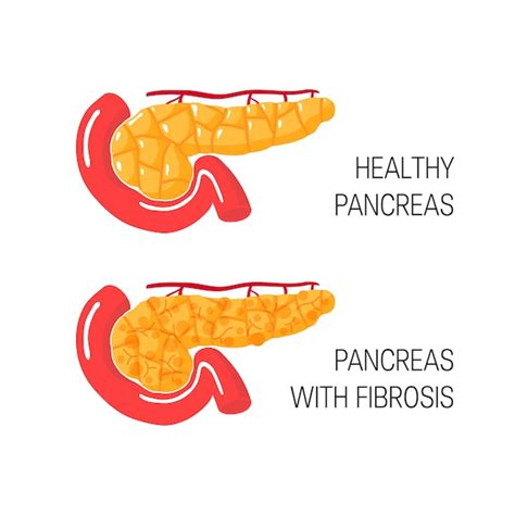 Premium Vector | Pancreatic fibrosis concept. medical illustration of ...