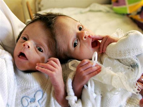 Conjoined twins: 40 amazing photos (GRAPHIC IMAGES) - Photo 26 ...