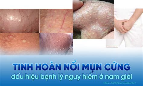 Tinh hoàn nổi mụn cứng - Dấu hiệu bệnh lý ở nam giới