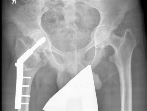 Pelvic X-ray of a young patient treated for a subcapital fracture of... | Download Scientific ...