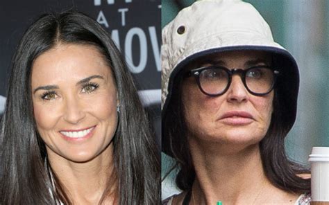 Shocking! Demi Moore's 'Swollen' & 'Bruised' Face The Result Of Bad Plastic Surgery? | Star Magazine