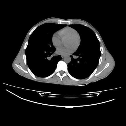 Pancoast tumor | Radiology Case | Radiopaedia.org