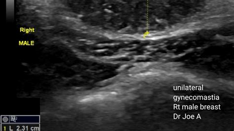 Male Gynecomastia Ultrasound