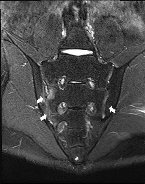 Magnetic resonance imaging (MRI) on diagnosis of juvenile ankylosing... | Download Scientific ...