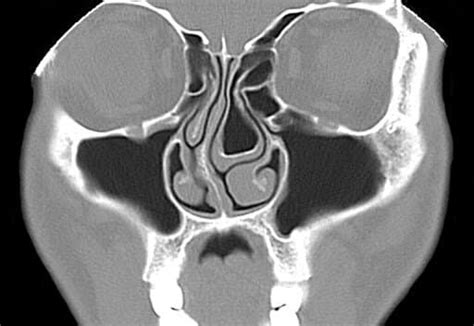 What is a Concha Bullosa? | Reddy Sinus