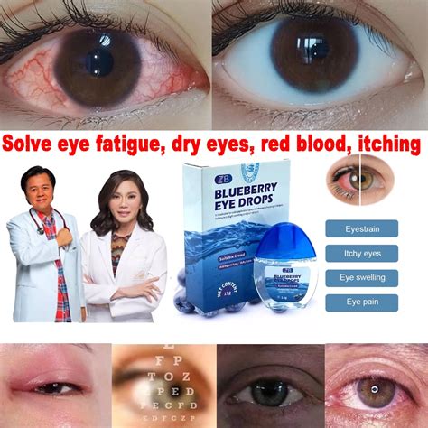 【COD】Blueberry Eye Drops | Itchy Eyes | Glaucoma | Eye Drops | Dry Eyes | Eye Drops | Sore Eyes ...