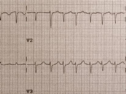 Pericardial Effusion: Causes, Symptoms, and Treatment