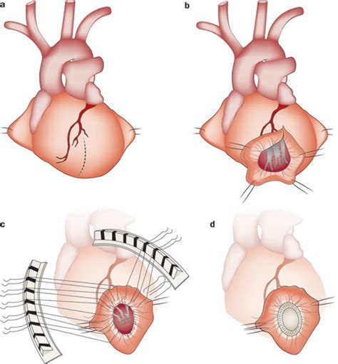 Cardiac Remodeling or Ventricular Remodeling surgery | Dr. S. K. Sinha