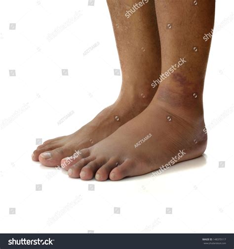 Left Ankle Sprain Swelling From Trauma On White Background. Stock Photo ...