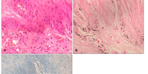 Histological examination from tongue mucosal lesion. (A) Basal layer... | Download Scientific ...