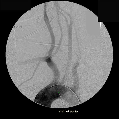 Index of /Neuro/Radiology/rad_vasculature/angio_aortic_arch/early