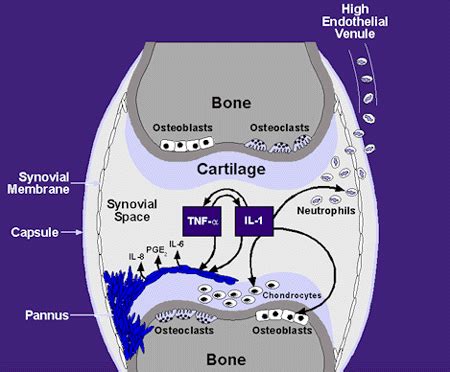 Interleukin-1 Inhibition at Treatment for Rheumatoid Arthritis on Johns Hopkins Arthritis