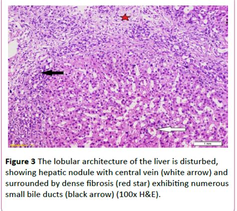 Congenital Hepatic Fibrosis (CHF): A Report of Two Cases and an O